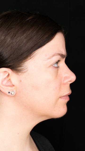 LG Led Mask Bare Face Right Side May 2019 - Bonnie Garner